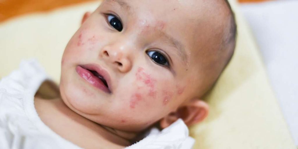 prévention des allergies